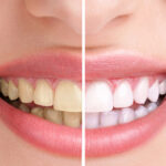 teeth-whitening