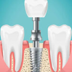 dental-implants