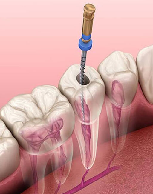 microscopic-root-canal-treatment